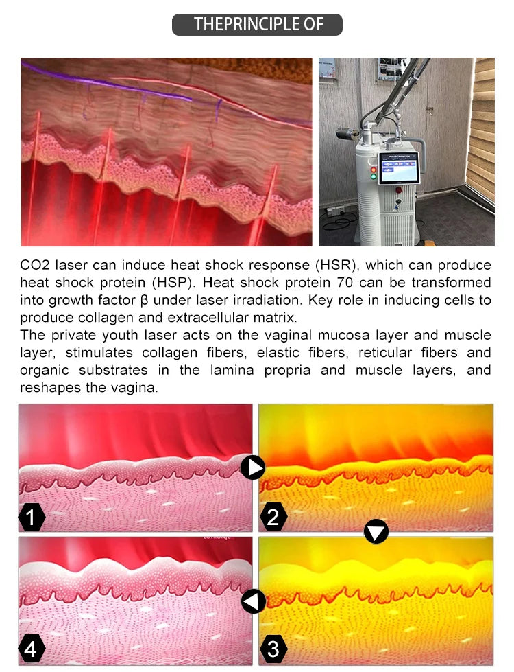 Machine de traitement laser fractionné 4D Fotona Co2, 10600nm, pour la resuction des cicatrices d'acné, nouveau design