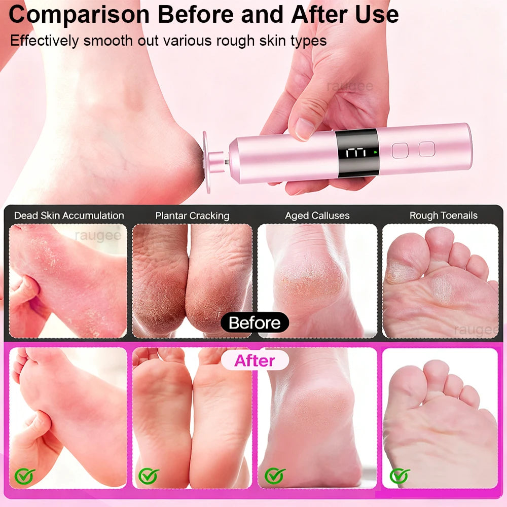 Appareil de soin des pieds pour peau rugueuse, callosités et ongles, résultats avant/après