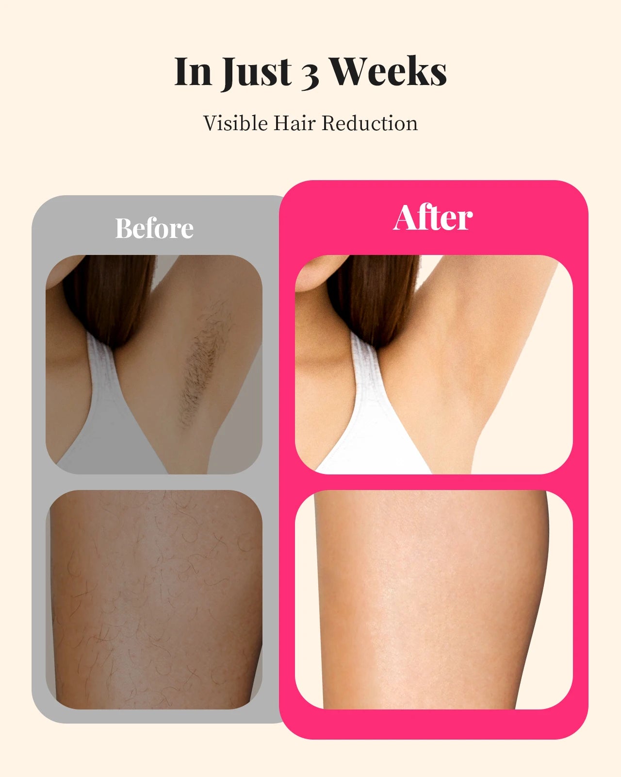 990000   Flashes Épilation au laser pour femmes et hommes Épilation IPL Corps Bikini et zones du visage Épilation permanente indolore